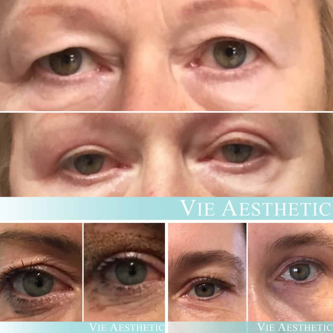 free consultation plexr save £150 vie aesthetics rayleigh essex holborn london