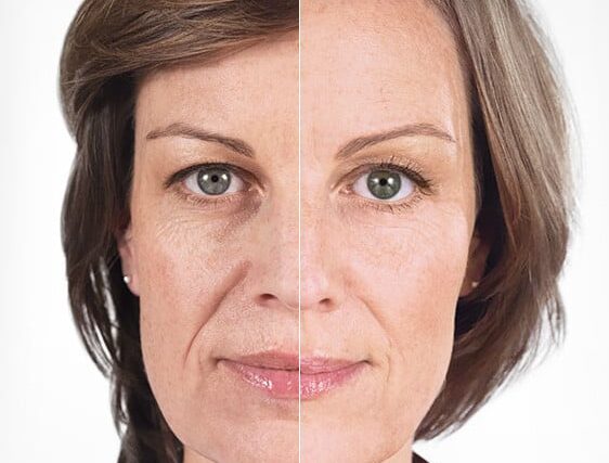 Before and after photo of a patient who had the Sculptra liquid facelift