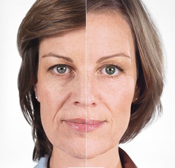 Before and after photo of a patient who had the Sculptra liquid facelift