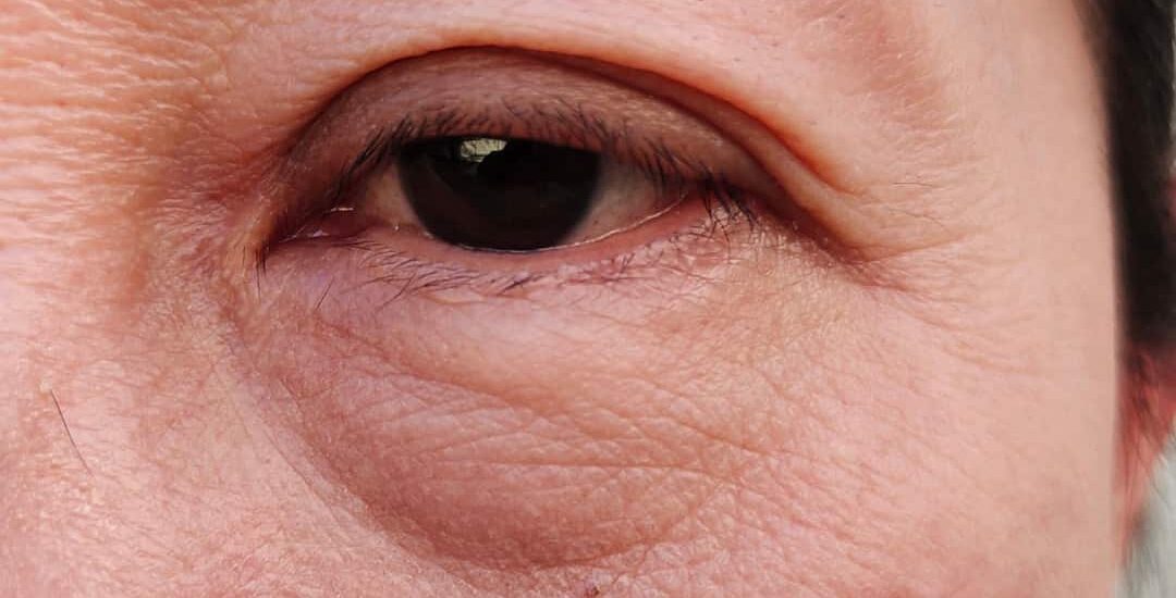 WEBSITE-Images-Square-58 malar bags festoons eye bags cure treatment essex rayleigh holborn london doctor non surgical