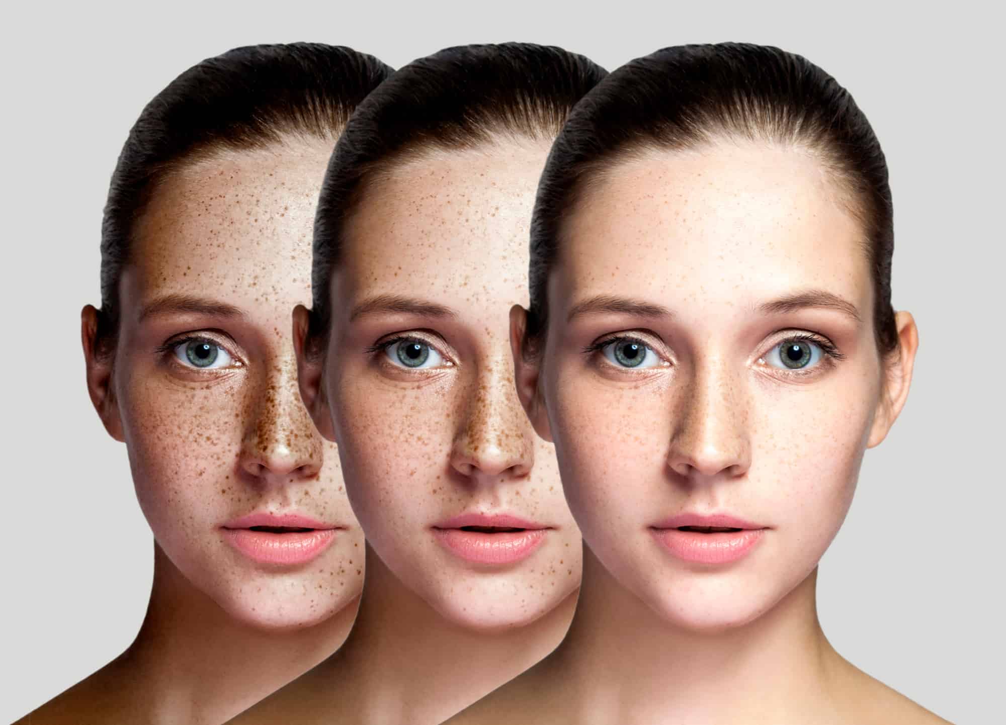 young woman showing benefits of Lumecca treatment for freckles and pigmentation disorders
