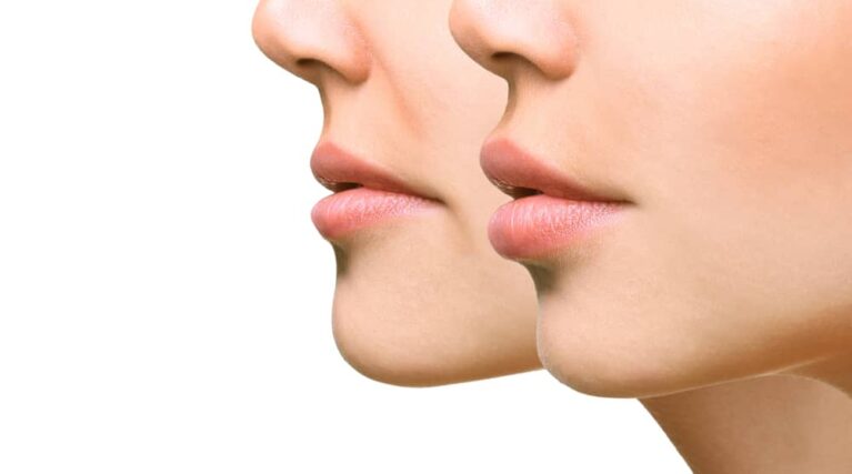 lips7 Models show off defined lips after Princess Filler for lips treatment