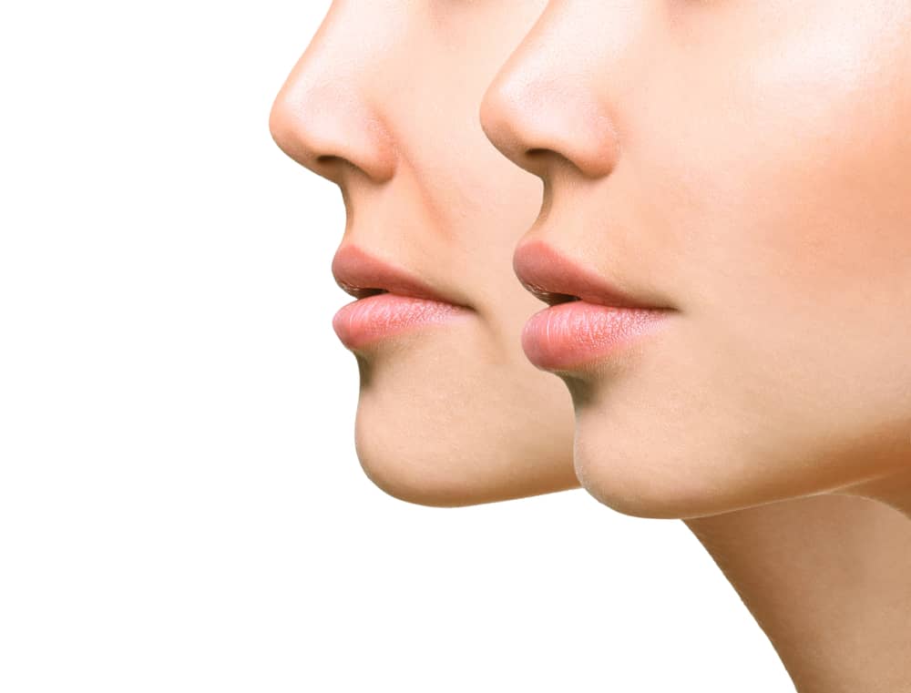 Models show off defined lips after Princess Filler for lips treatment
