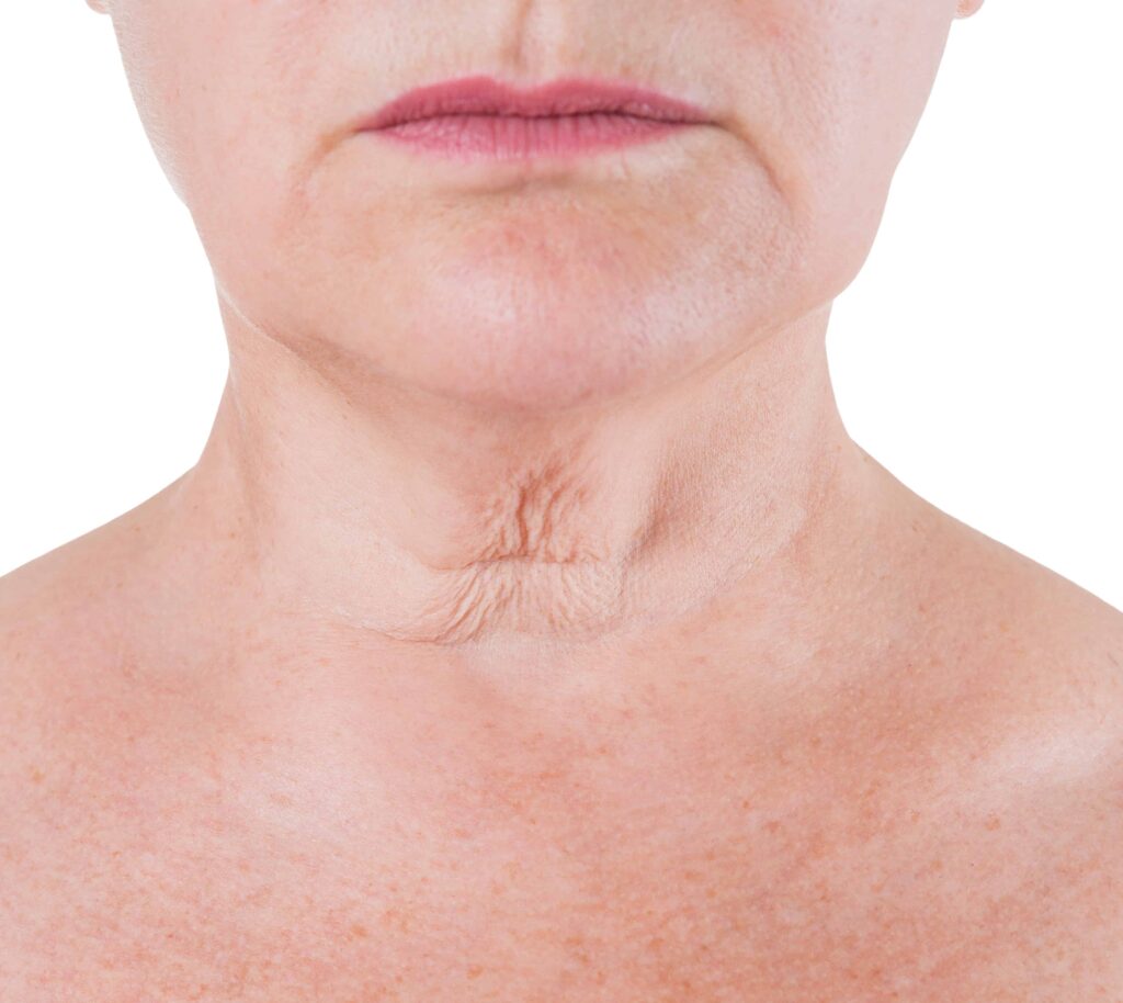 woman with loose skin and wrinkles on her neck caused by ageing