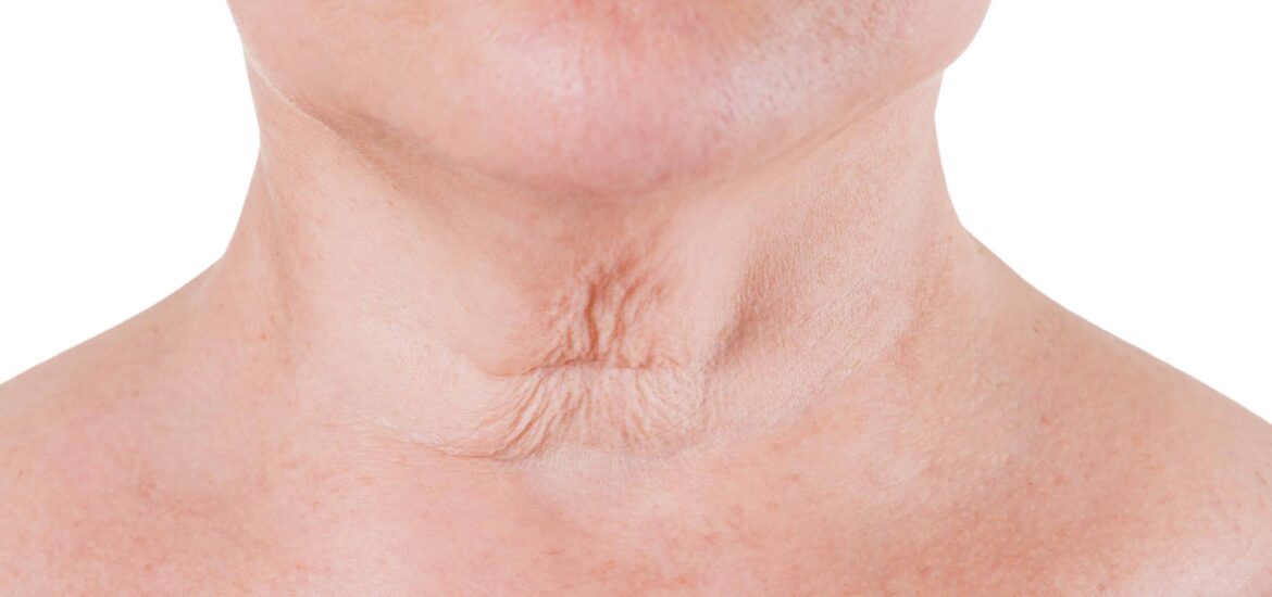 neck-ageing-concern woman with loose skin and wrinkles on her neck caused by ageing