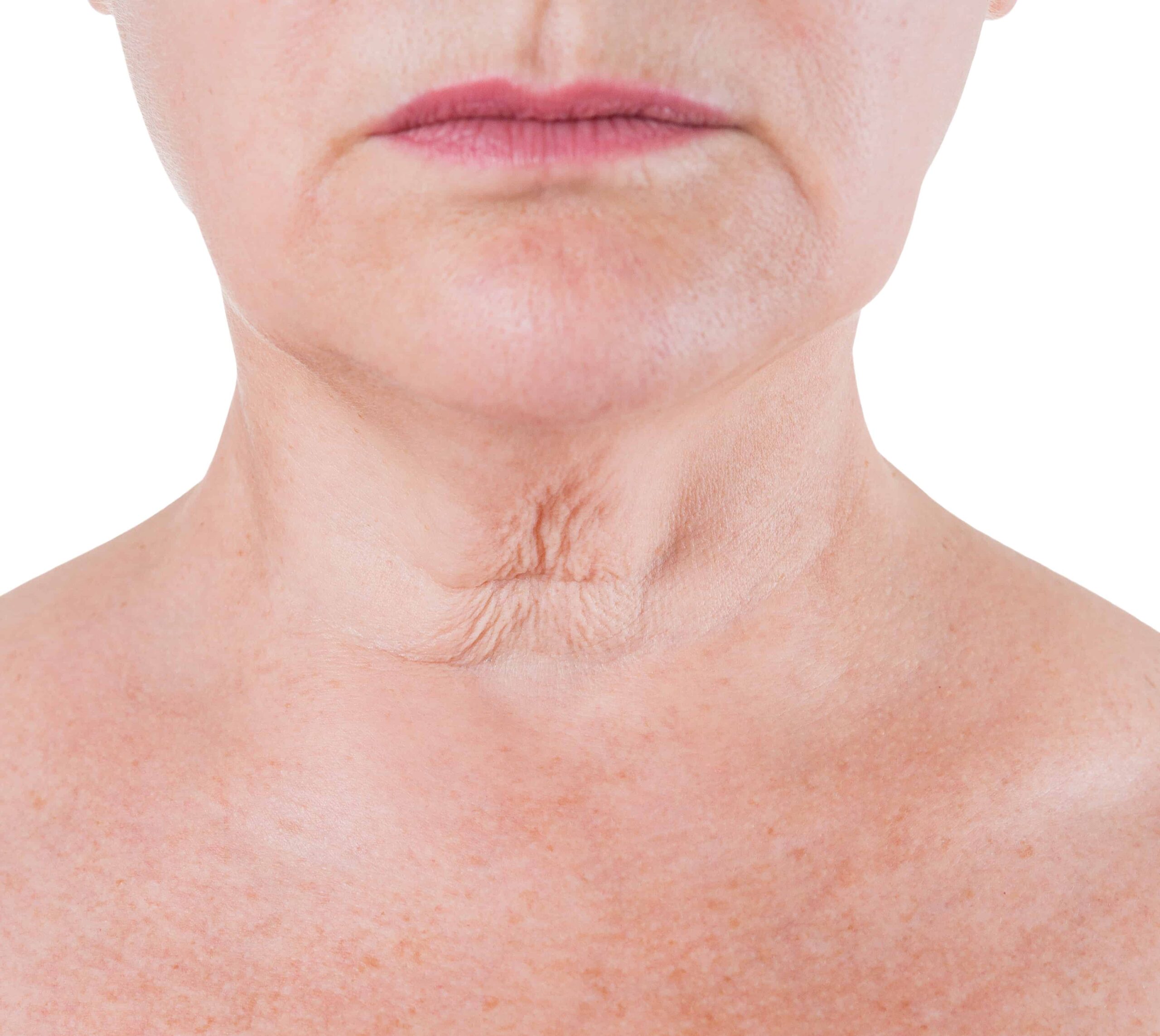 woman with loose skin and wrinkles on her neck caused by ageing