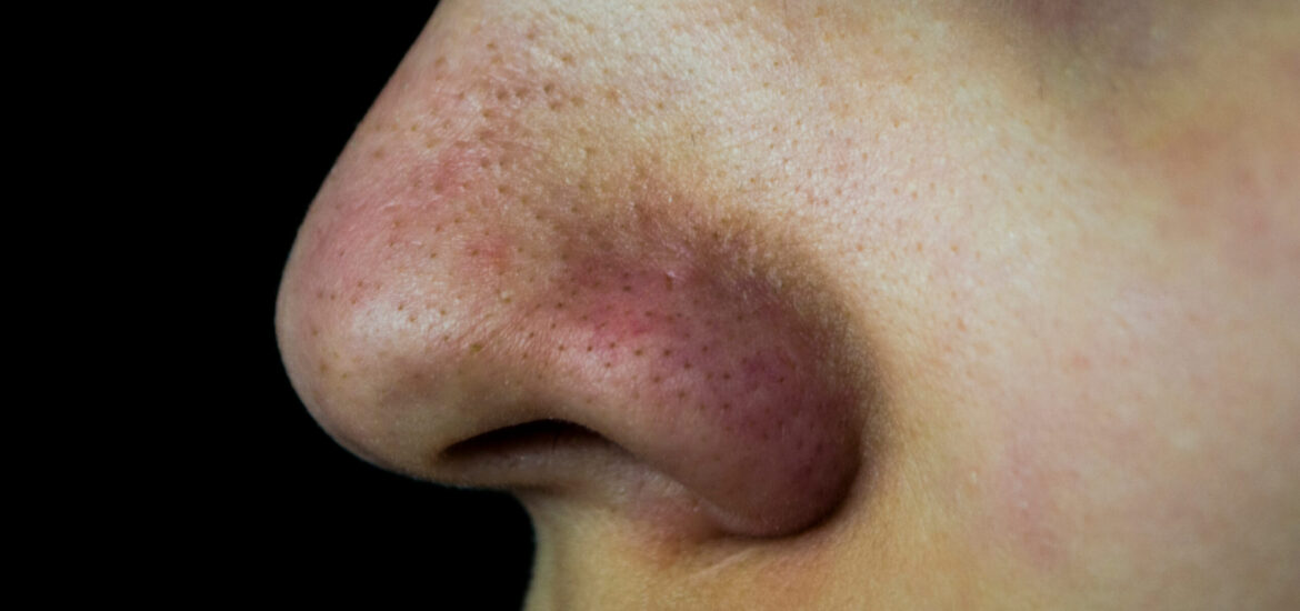 shutterstock_1014279685 Person suffering from blocked pores and blackheads on their nose