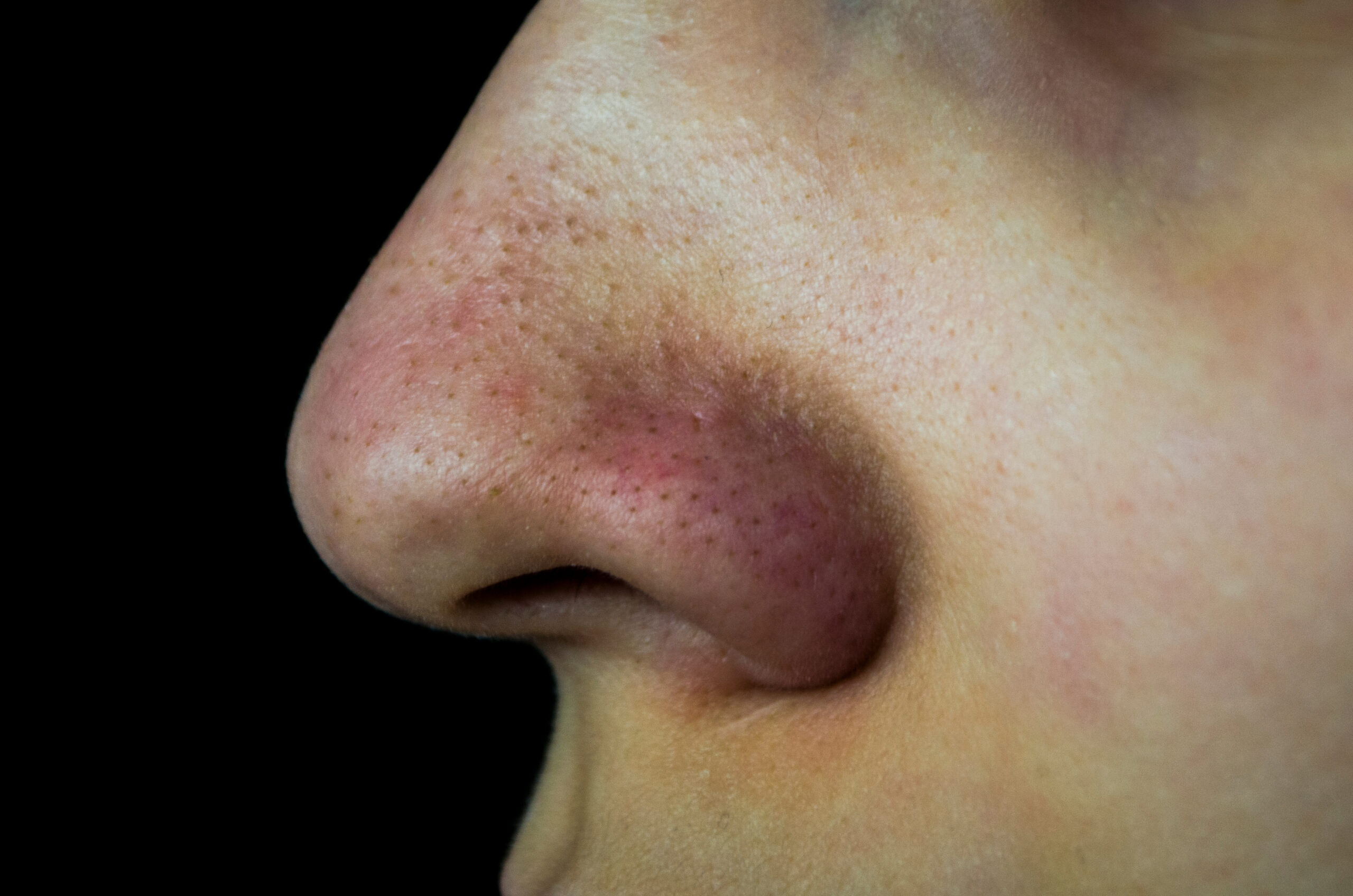 Person suffering from blocked pores and blackheads on their nose