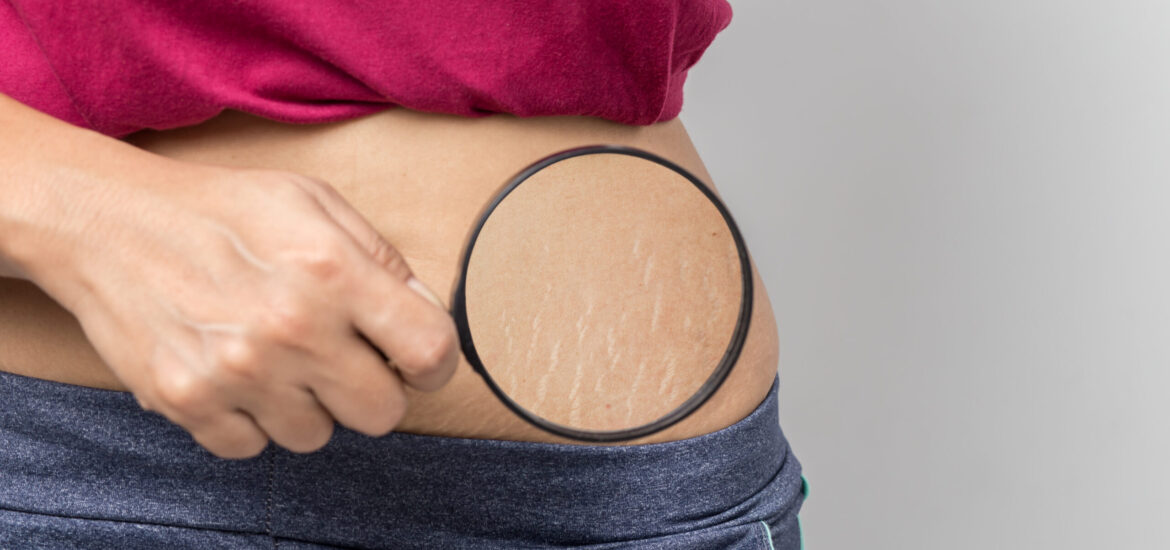 shutterstock_1105073645 stretch marks on a woman's stomach