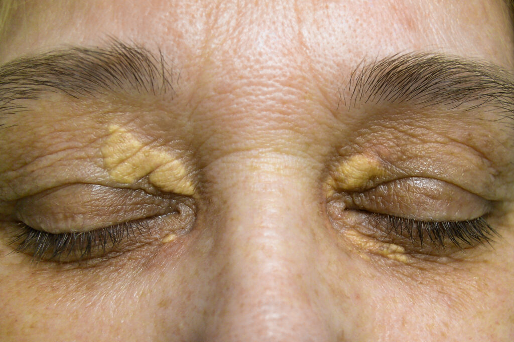 Xanthelasma around a woman's eyes
