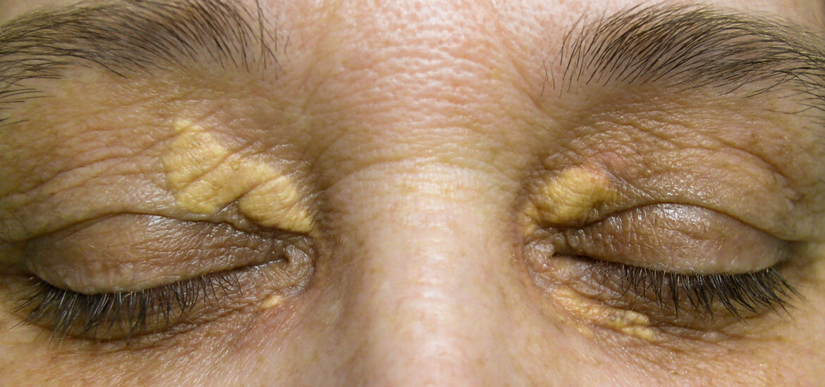 shutterstock_1108460534 Xanthelasma around a woman's eyes