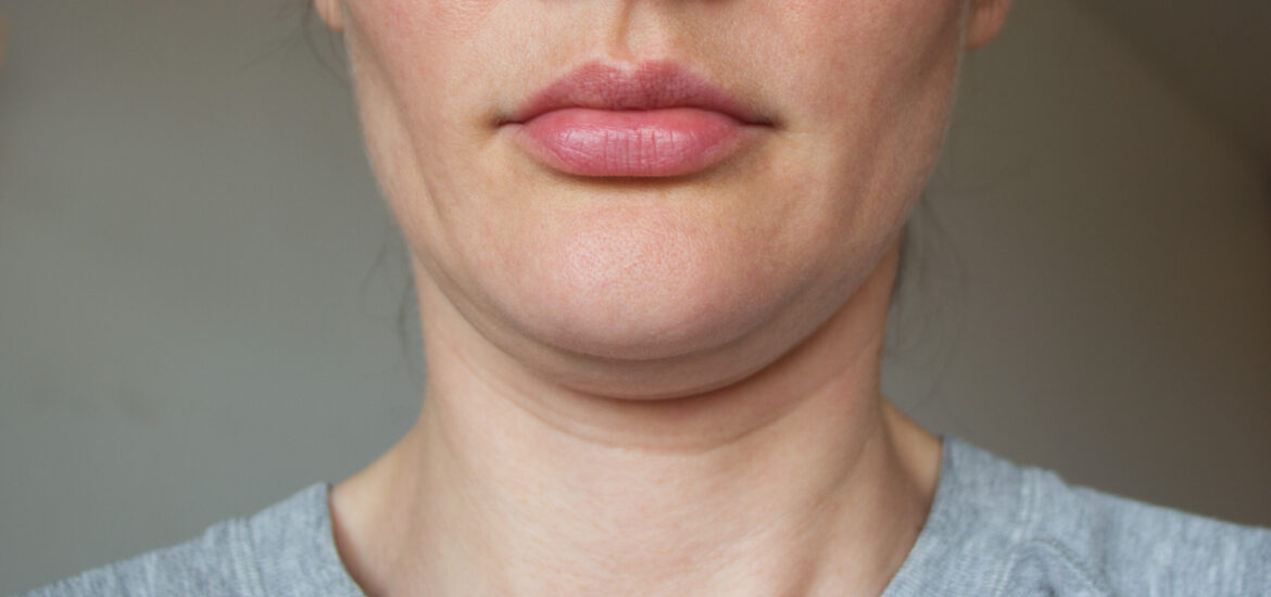 shutterstock_1130900999 a sporty woman suffering from loss of facial volume caused by gym face