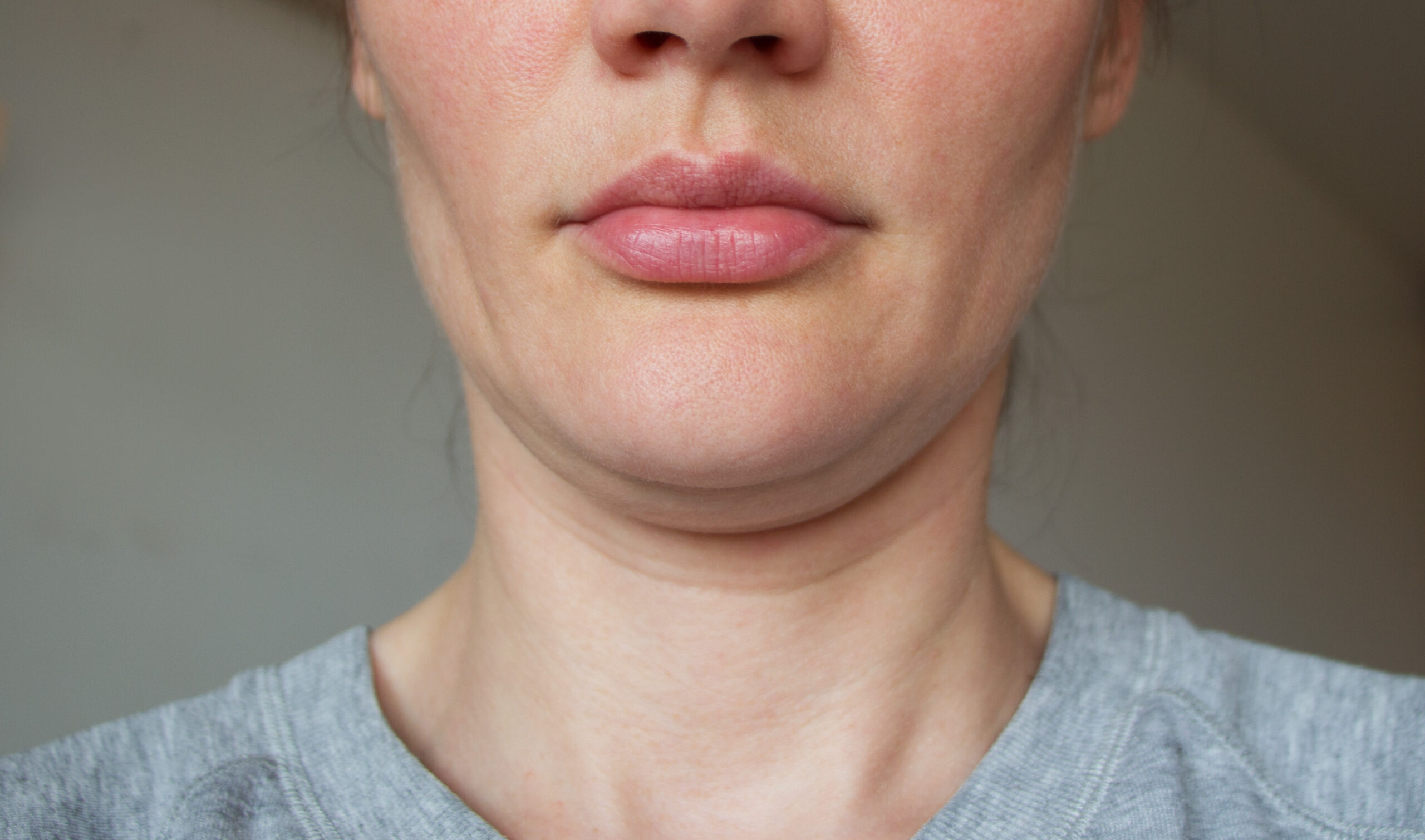 a sporty woman suffering from loss of facial volume caused by gym face