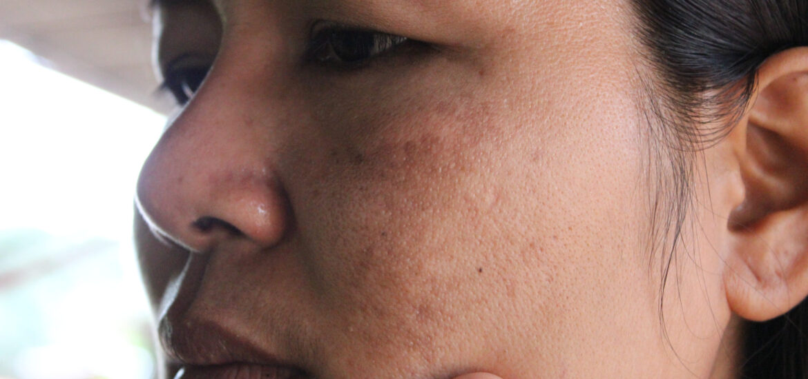 shutterstock_1145813501 woman with dull skin problems on her face