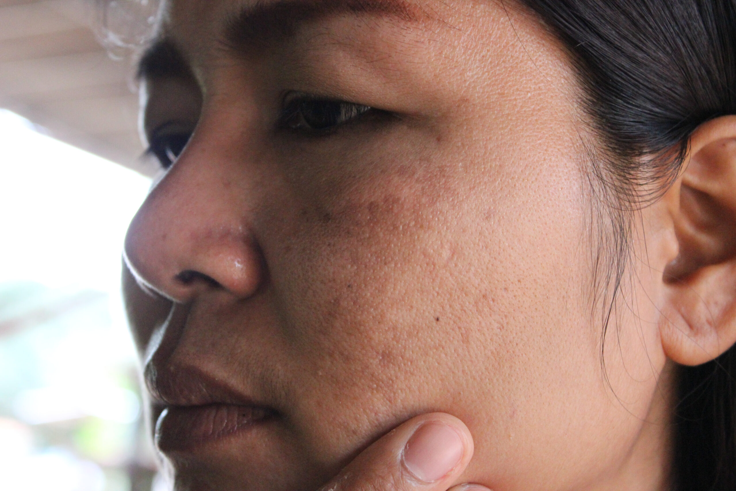 woman with dull skin problems on her face