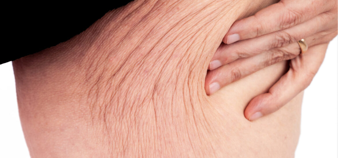 shutterstock_1206018007 saggy skin on the thighs