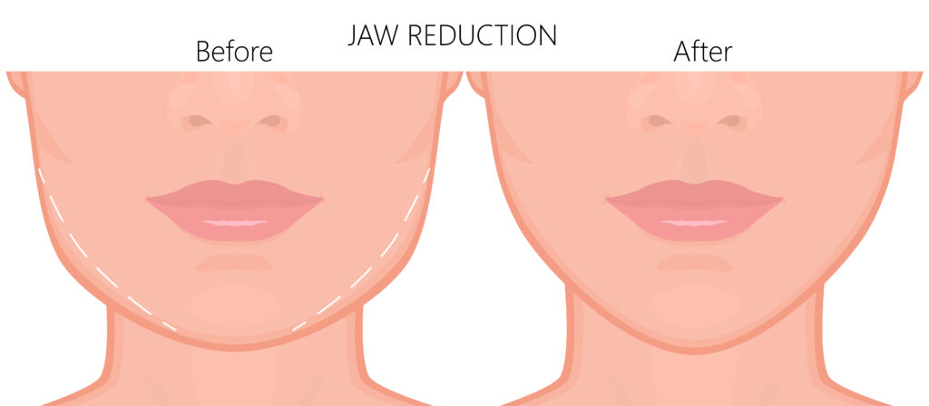 diagram showing non-surgical jaw reshaping and jawline reduction