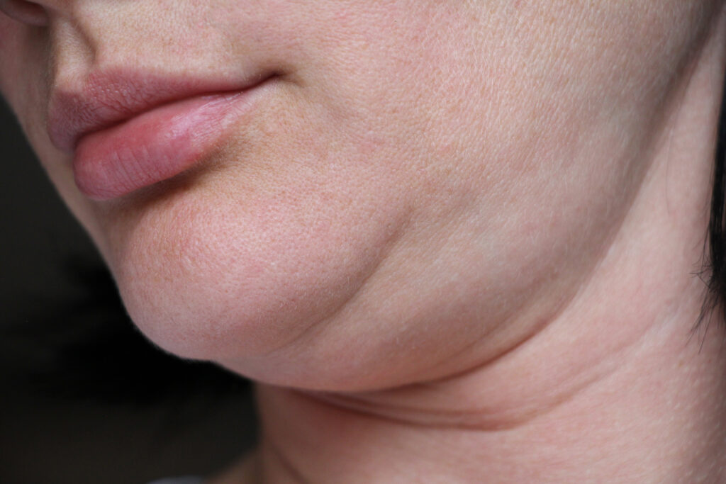 woman with a double chin considers a non-surgical fat reduction procedure