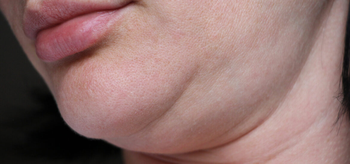 shutterstock_1250498467 woman with a double chin considers a non-surgical fat reduction procedure