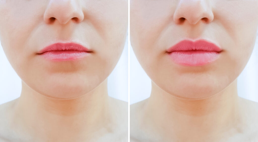 woman with thin lips has lip filler treatment to add volume