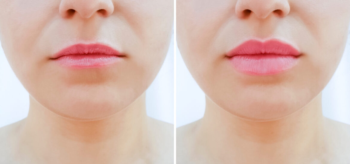 shutterstock_1267612375 woman with thin lips has lip filler treatment to add volume