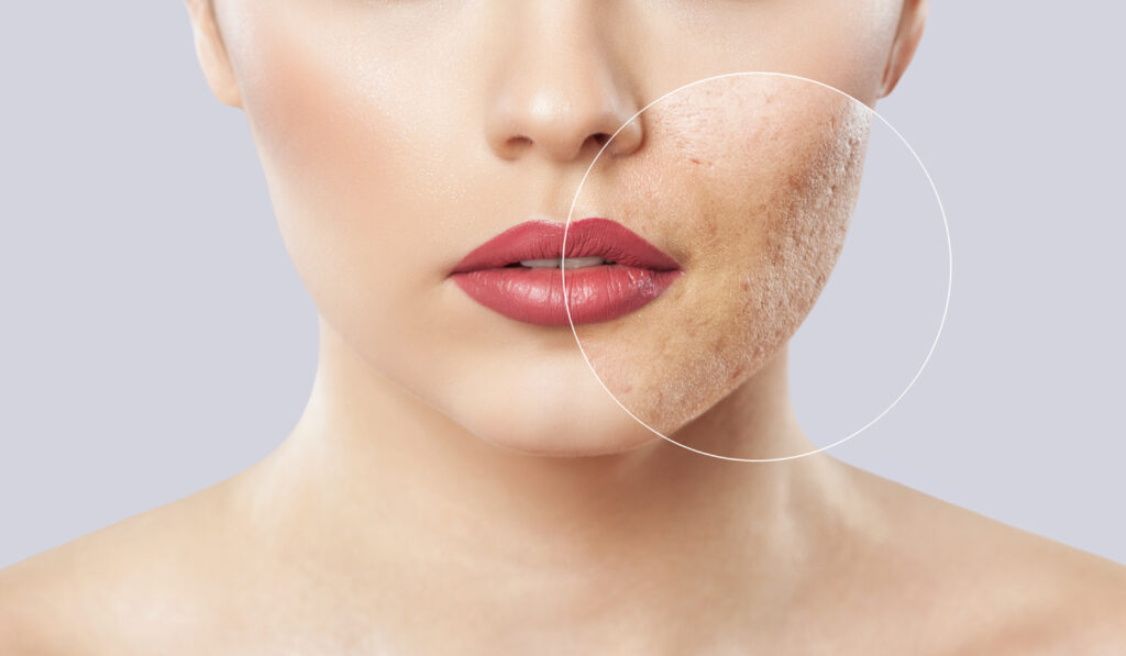 young woman with acne on her face
