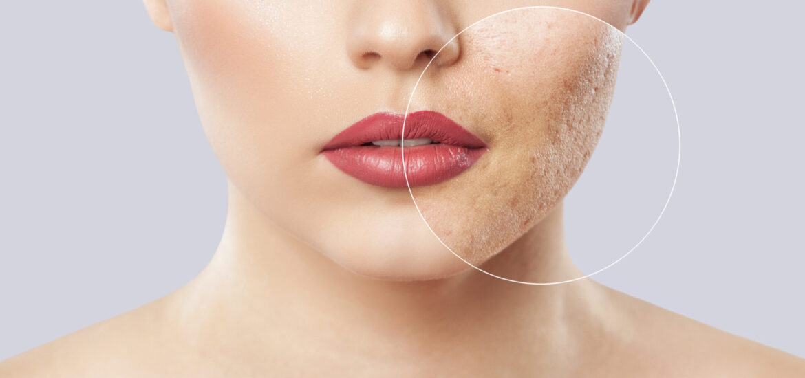 shutterstock_1346981630 young woman with acne on her face