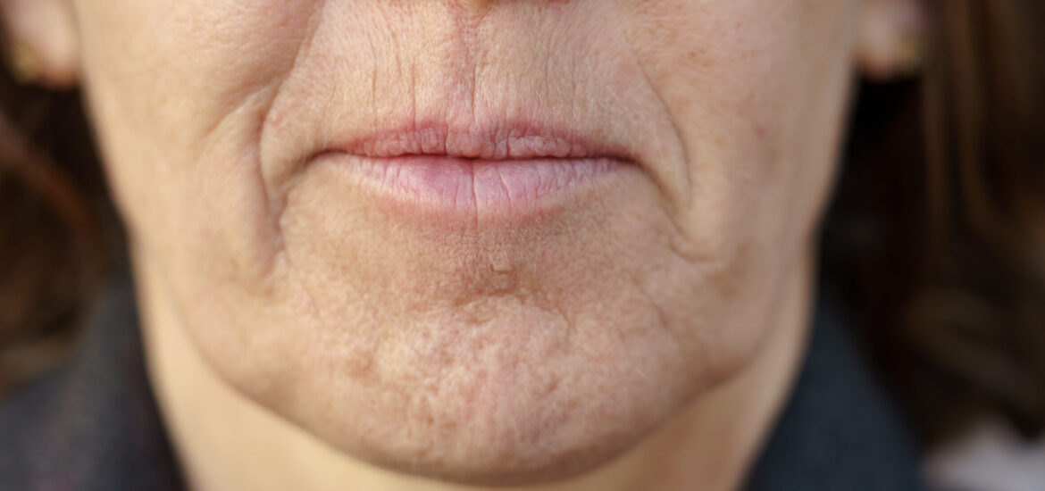 shutterstock_1349767769 woman with fine lines and wrinkles around her cheeks and mouth