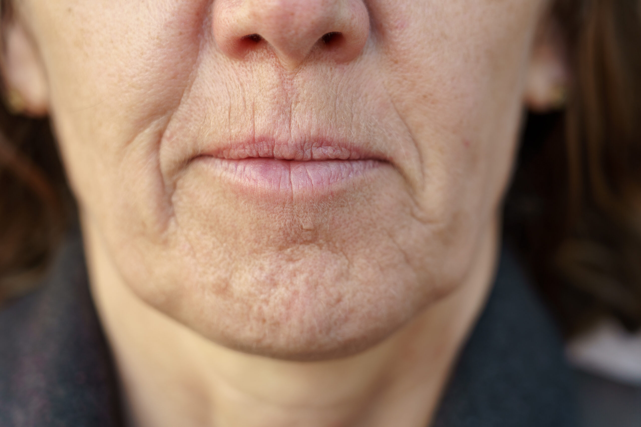 woman with fine lines and wrinkles around her cheeks and mouth