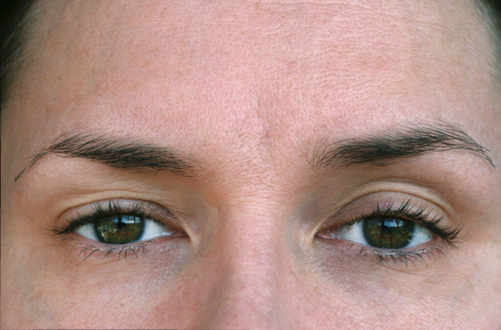 woman with mild hooded or droopy eyelids concerns