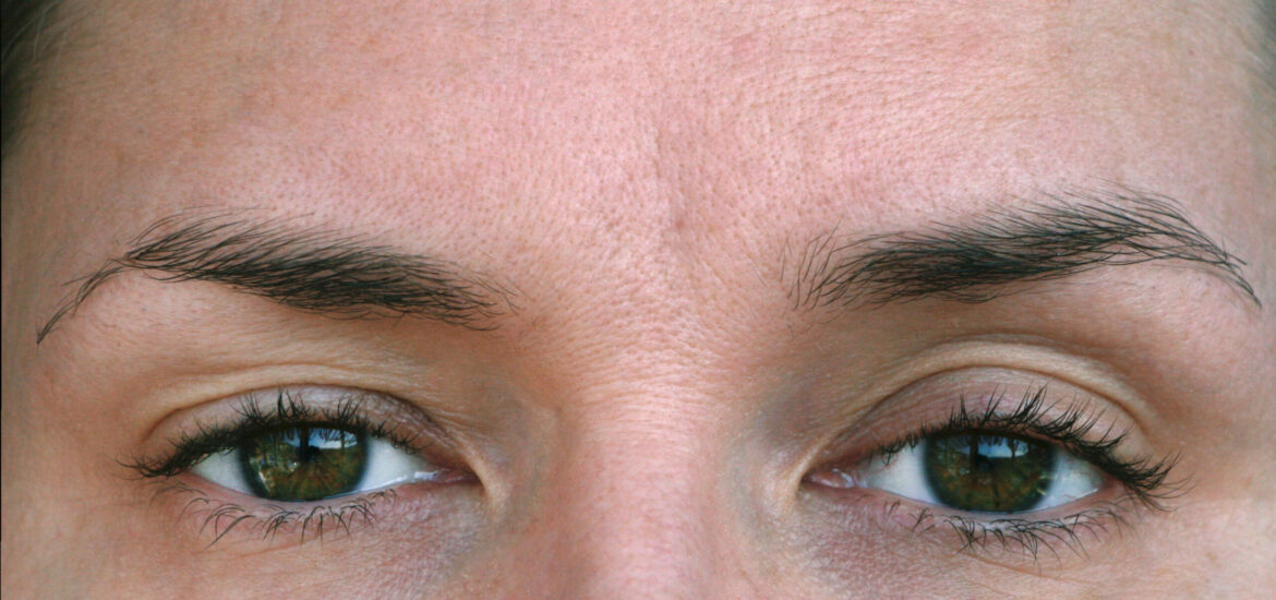 shutterstock_1369475189 woman with mild hooded or droopy eyelids concerns
