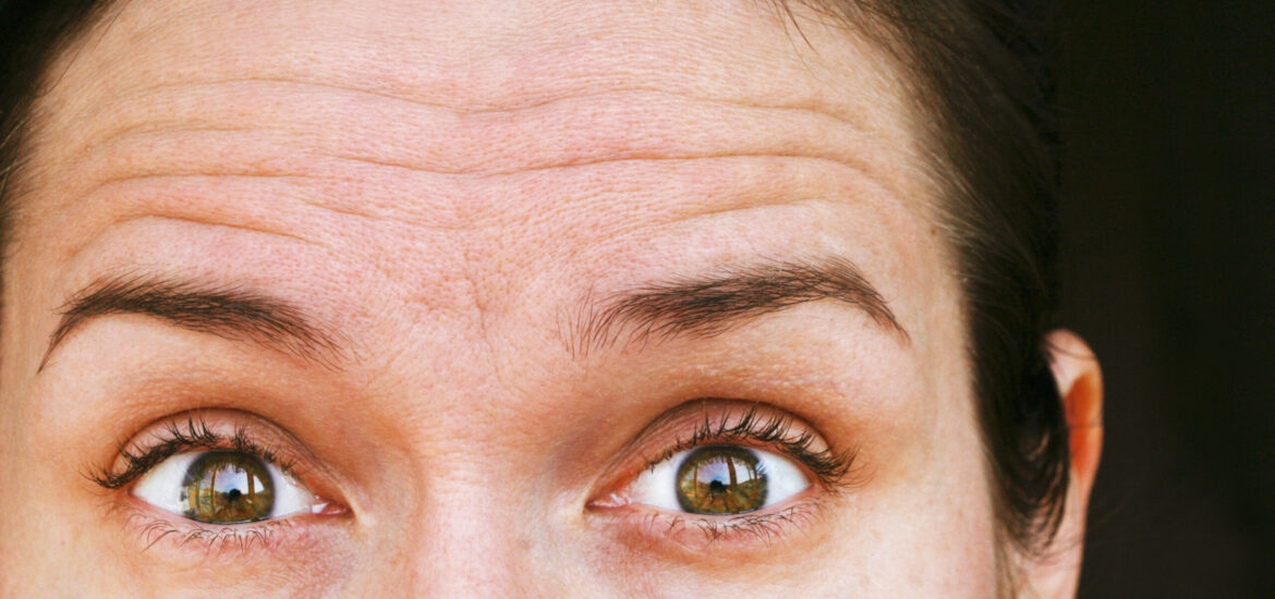 shutterstock_1369488173 frown lines and forehead wrinkles on a woman in her 30s