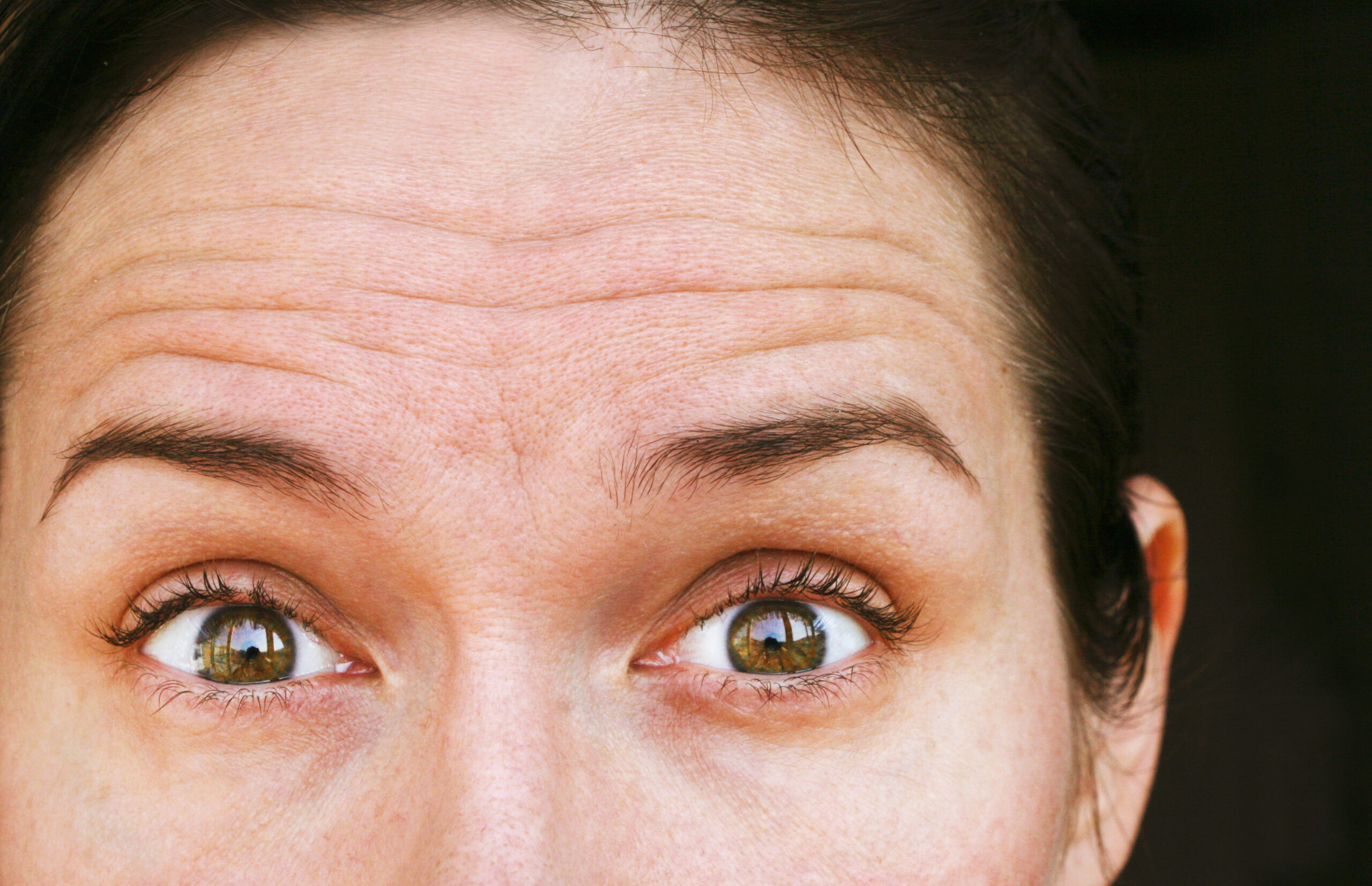 frown lines and forehead wrinkles on a woman in her 30s