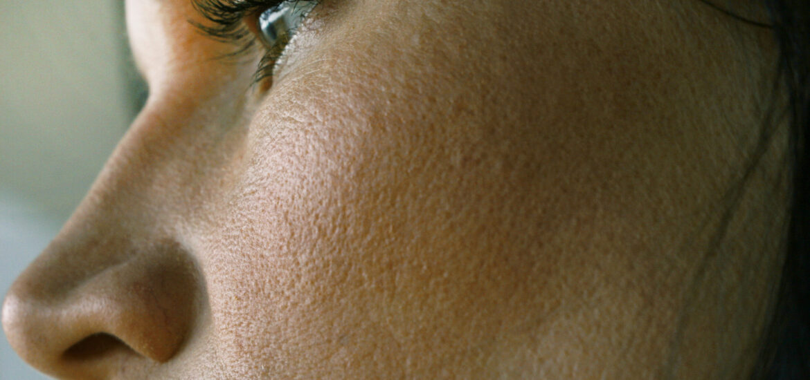 shutterstock_1409142875 woman with large pores or open pores on their face