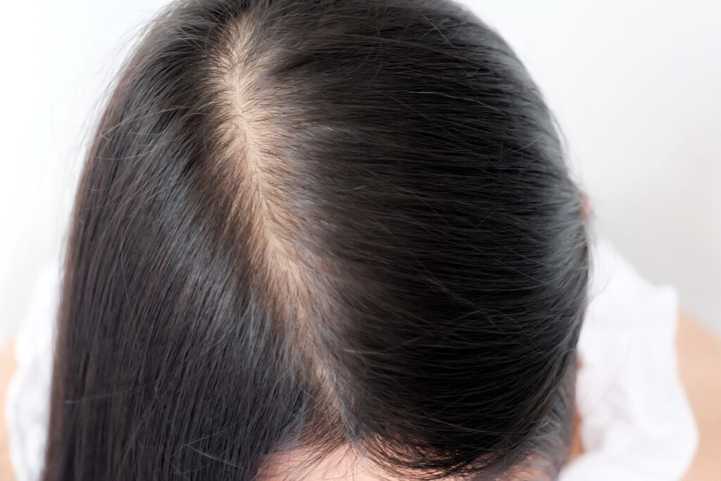 woman with wide part caused by hair loss