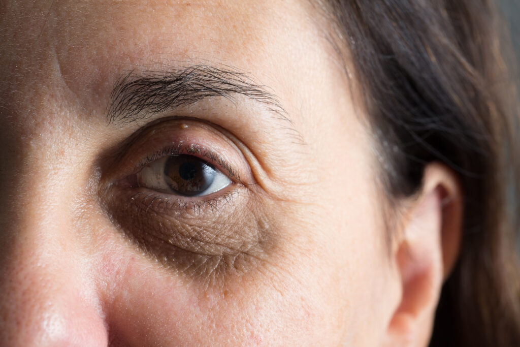 dark circles and eye bags on a middle-aged woman