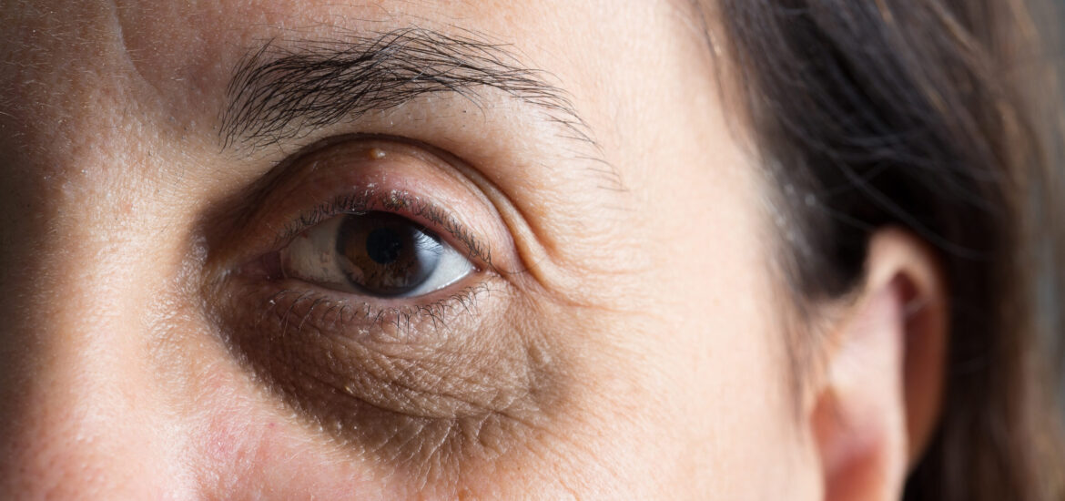 shutterstock_1438308116 dark circles and eye bags on a middle-aged woman