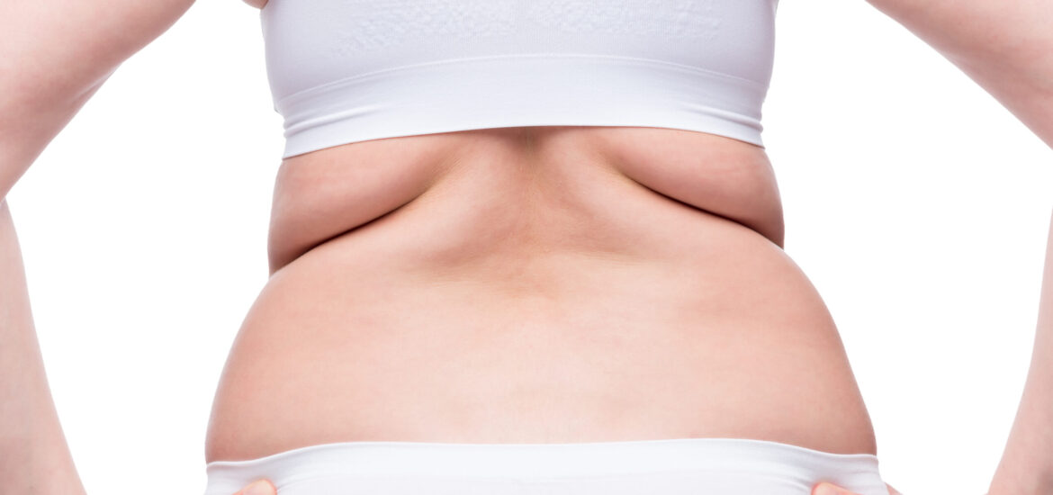 shutterstock_1449972614 woman with pockets of fat on her back considers non-surgical body toning procedure