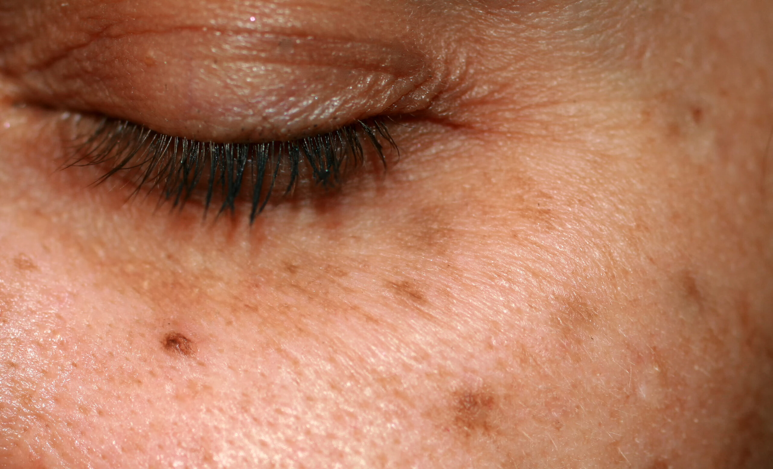 person with pigmentation and hyperpigmentation concerns on their face