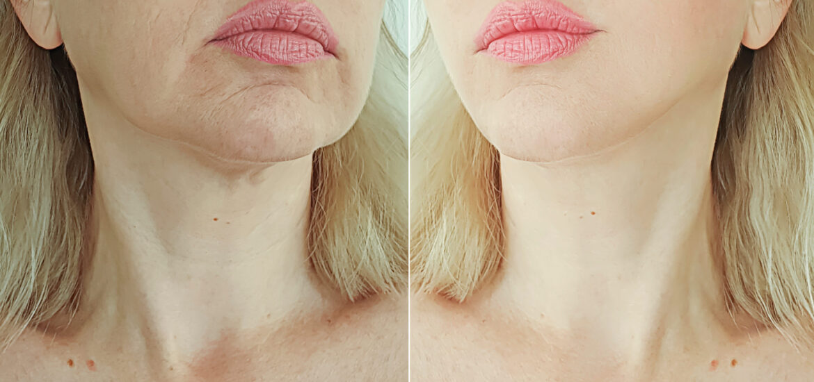 shutterstock_1505862887 woman suffers from loss of facial volume and contours caused by ageing