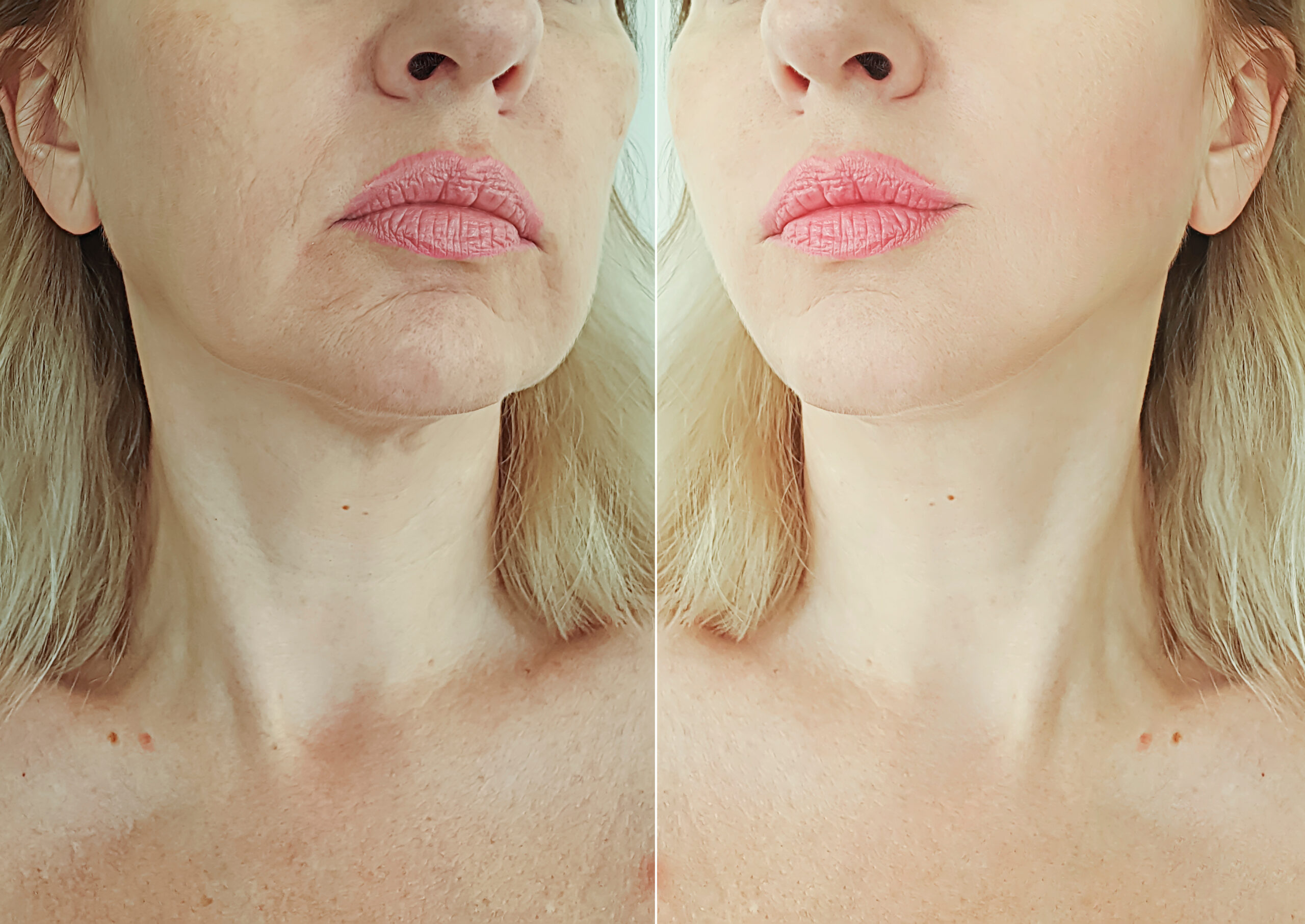 woman suffers from loss of facial volume and contours caused by ageing