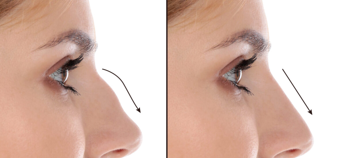 shutterstock_1534729844 woman with a bumpy, uneven nose has a non-surgical nose job to correct its shape