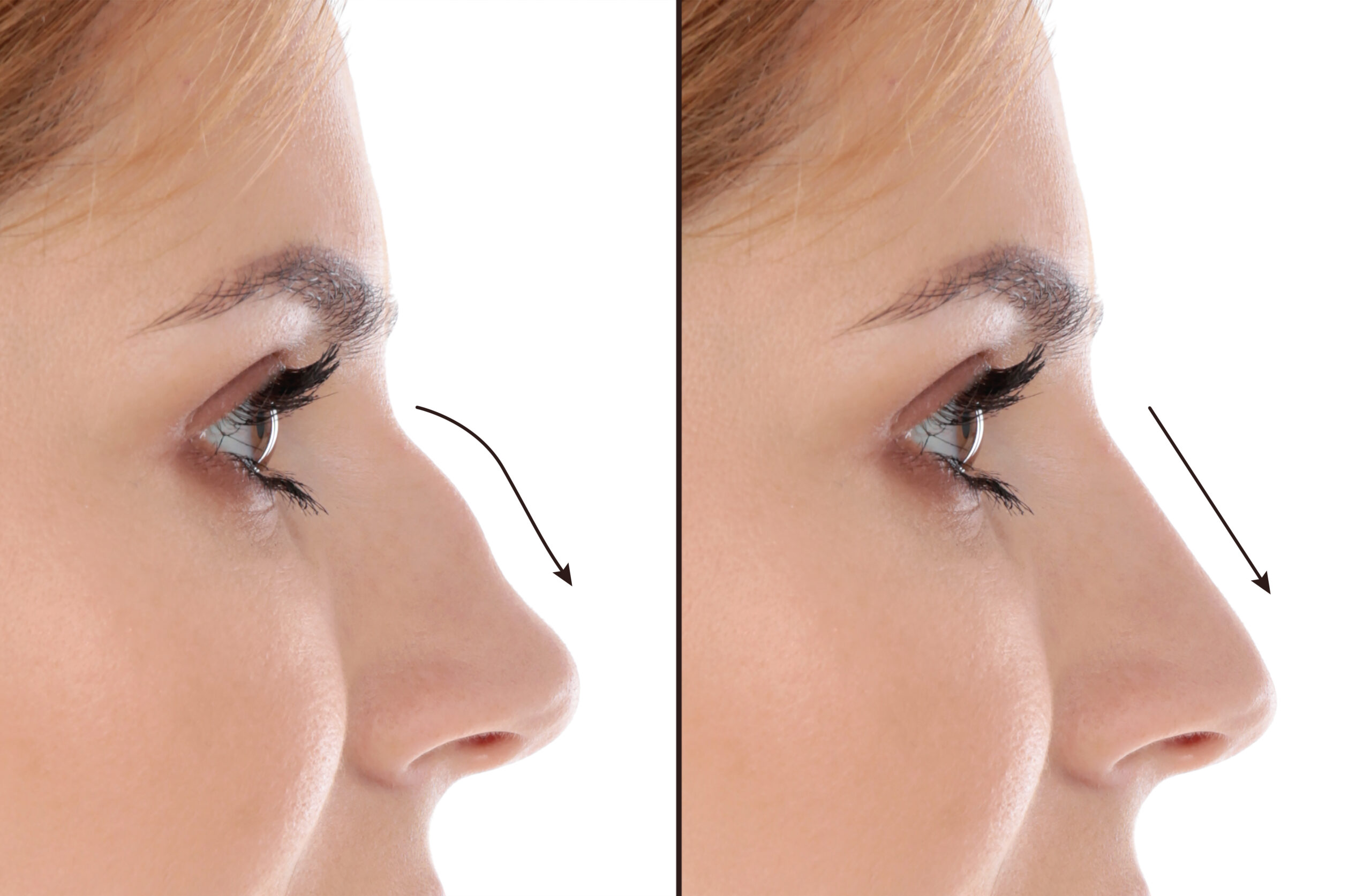 woman with a bumpy, uneven nose has a non-surgical nose job to correct its shape