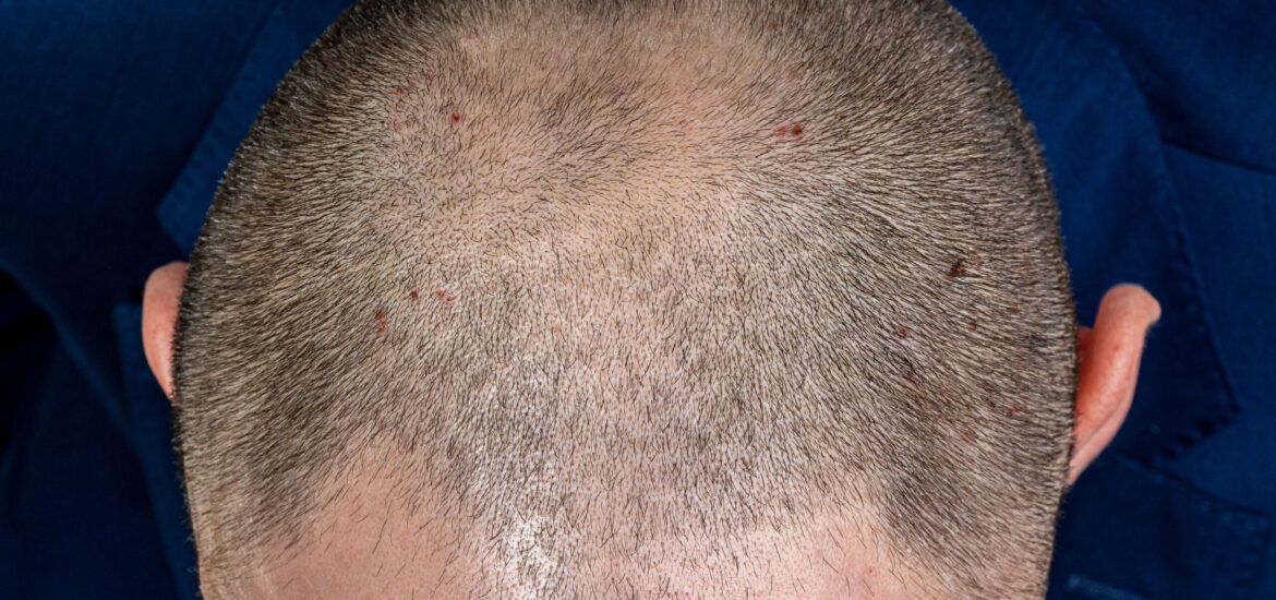 shutterstock_1550127461 Young man with androgenetic alopecia or male pattern baldness