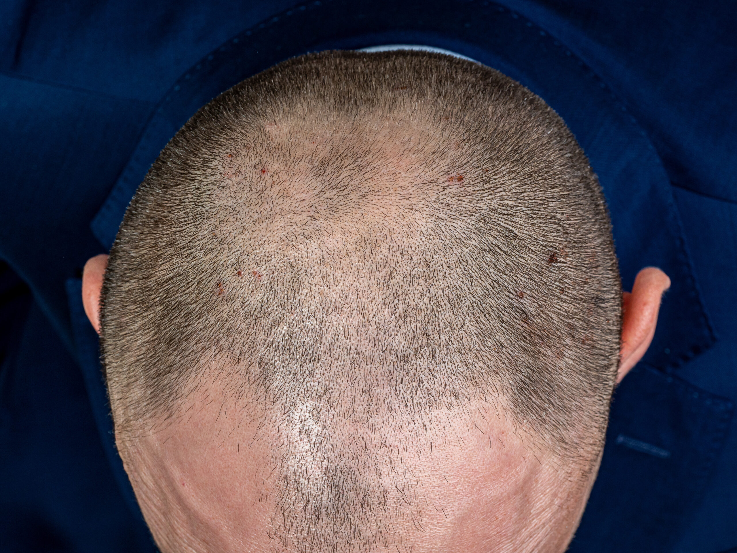 Young man with androgenetic alopecia or male pattern baldness