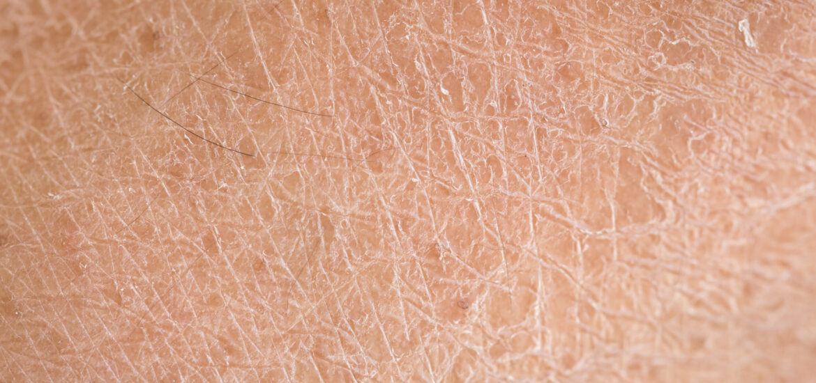 shutterstock_260573114 Close-up photo of dry skin