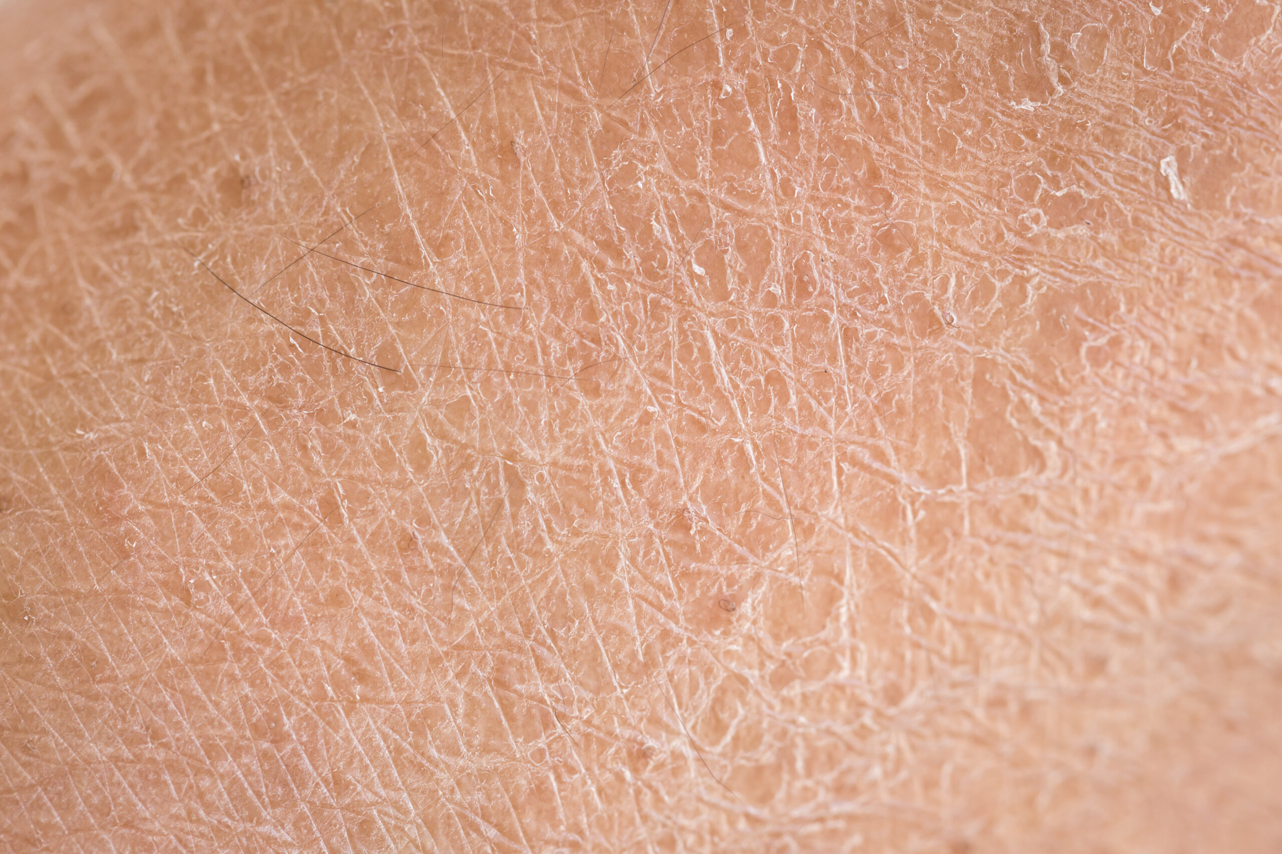 Close-up photo of dry skin