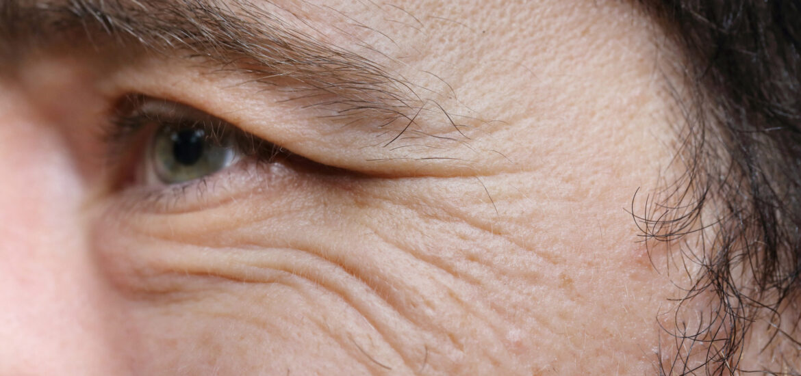 shutterstock_380093533 Crow's feet on a man caused by ageing or lifestyle