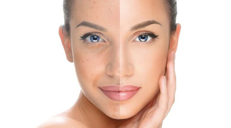 shutterstock_385492231 woman with dull skin showing the effects of a medical chemical peel treatment