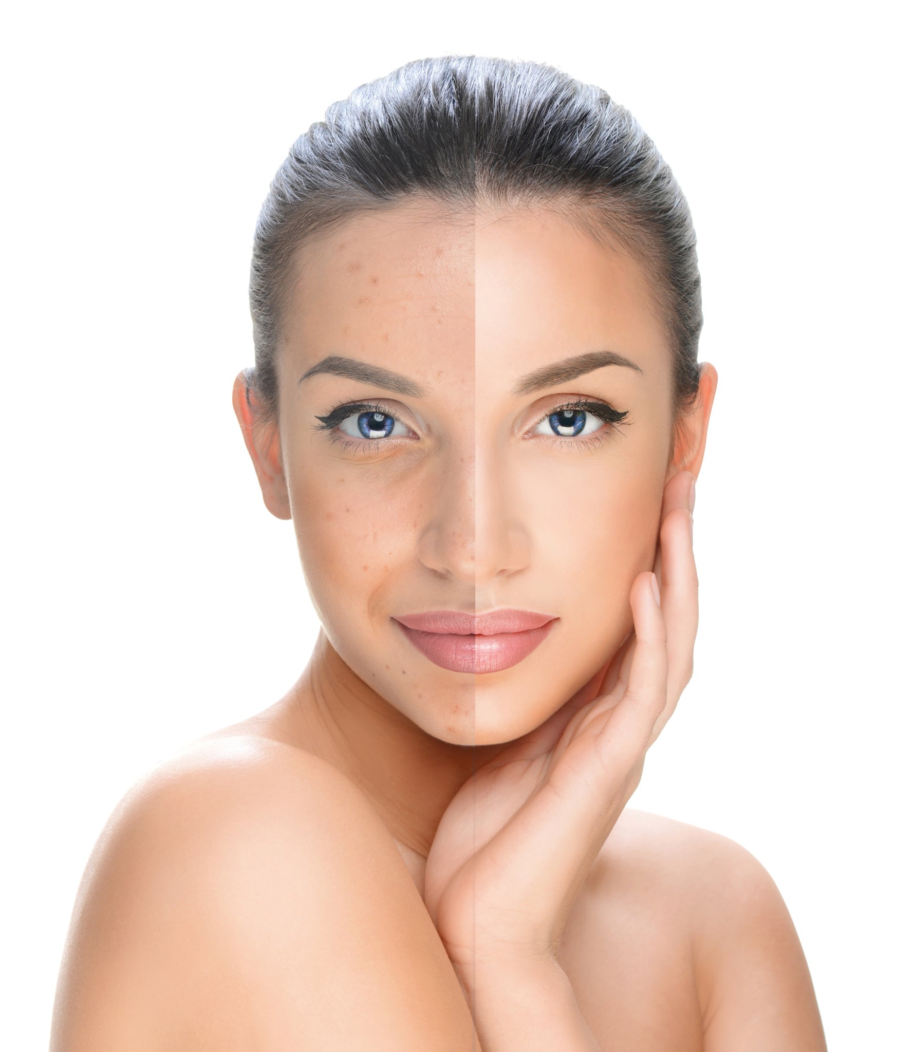 woman with dull skin showing the effects of a medical chemical peel treatment